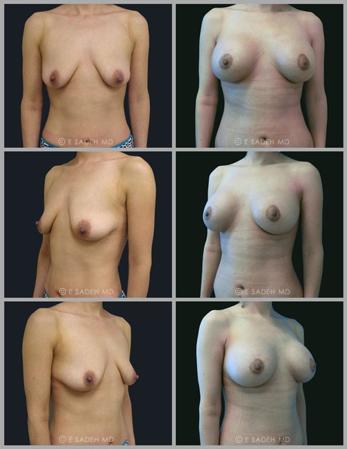 breast-lift-12-_ניתוח_הרמת_חזה