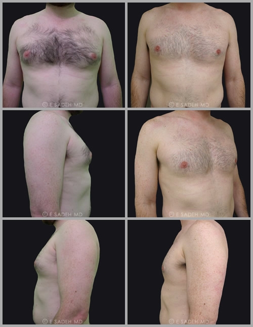 לגבר-לפני-ואחרי-שאיבת-שומן