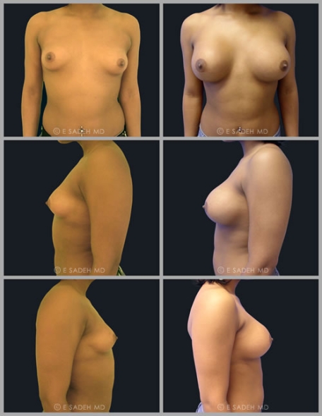  Breast Asymmetr7