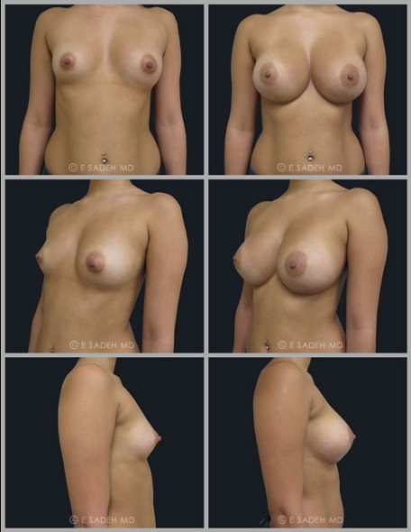  Breast Asymmetr8