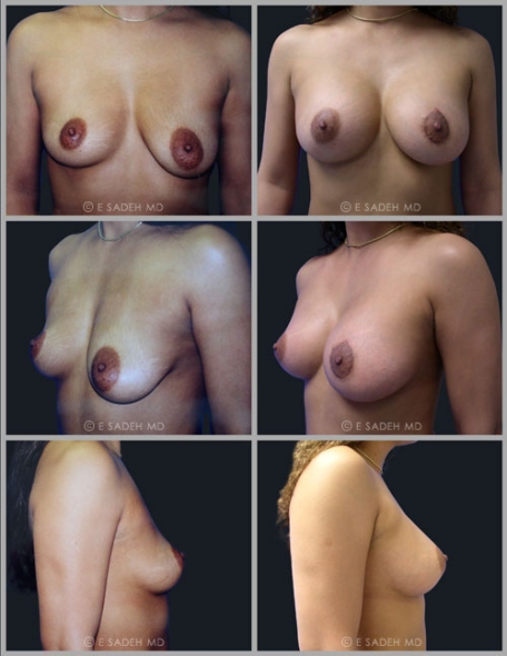  Breast Asymmetr9