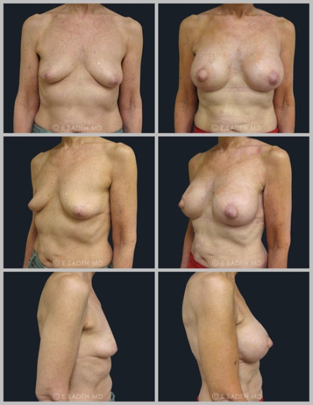  Breast Asymmetry1