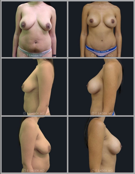  Breast Asymmetry3