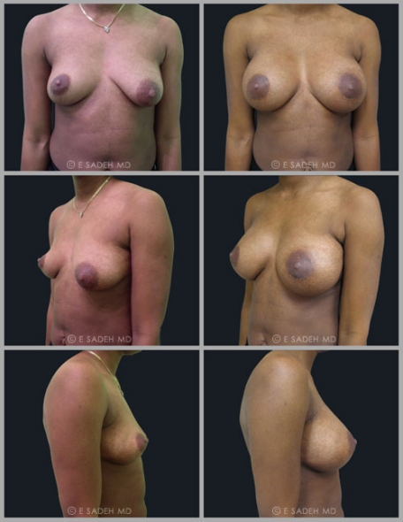  Breast Asymmetry5