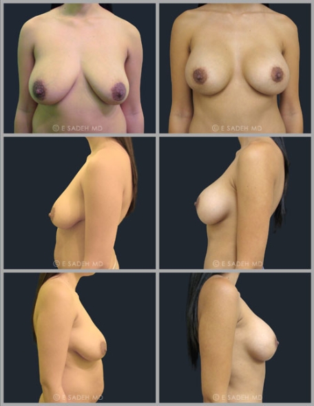 Breast Lift 14