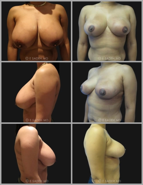 Breast Reduction 4