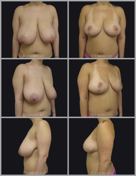  Breast Reduction 1