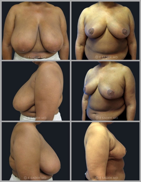  Breast Reduction 10