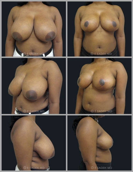  Breast Reduction 11