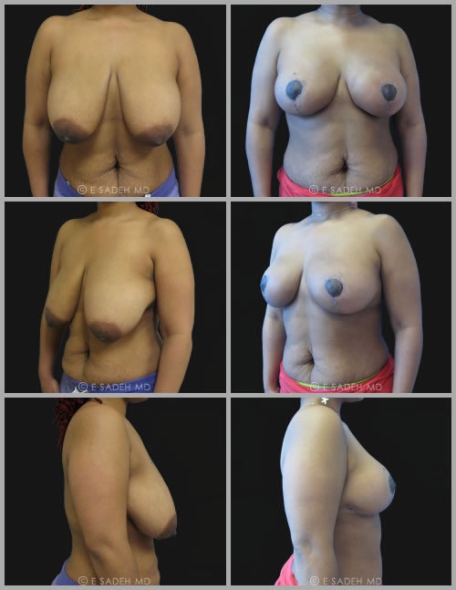  Breast Reduction 12
