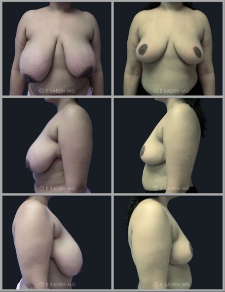  Breast Reduction 13