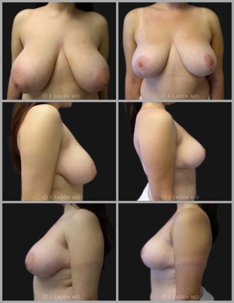  Breast Reduction 2