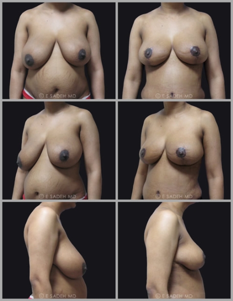  Breast Reduction 3