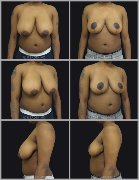  Breast Reduction 5