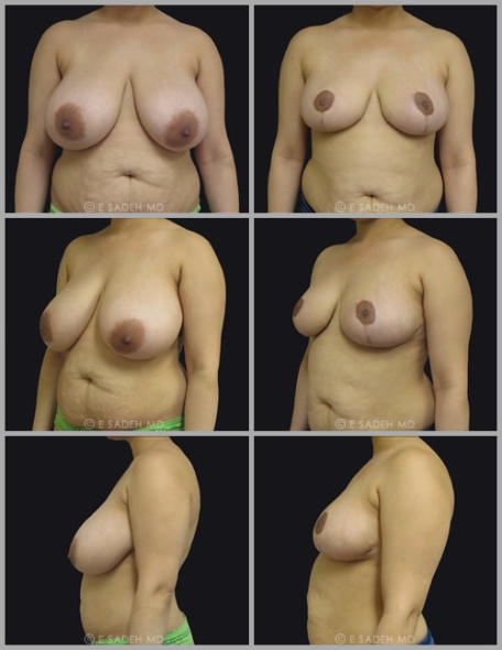  Breast Reduction 6
