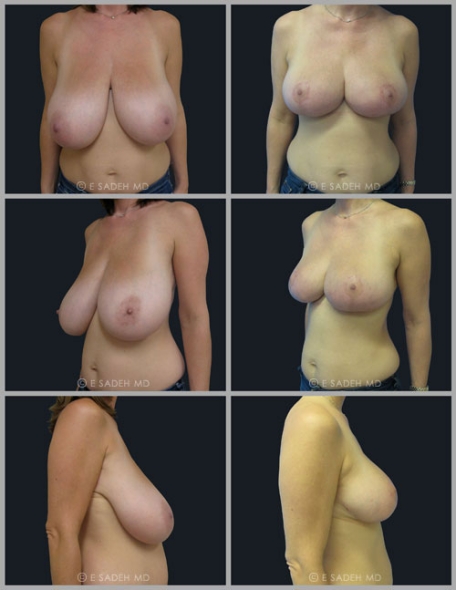  Breast Reduction 7