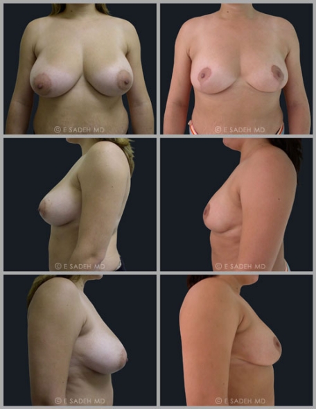  Breast Reduction 8