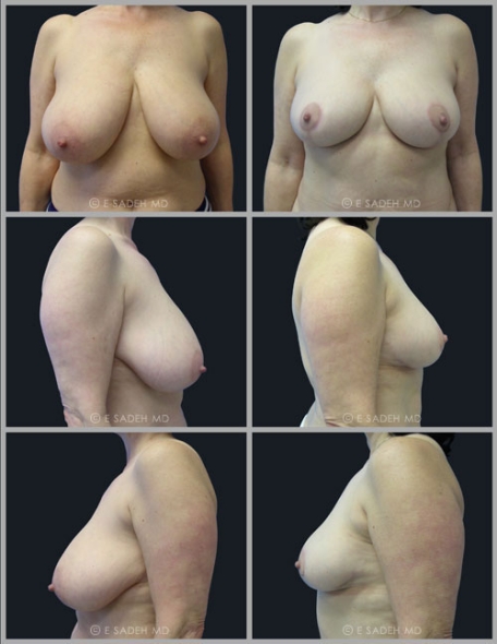  Breast Reduction 9