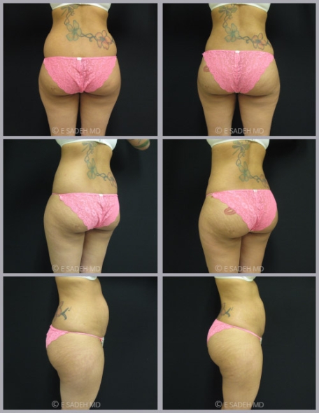 גלריית תמונות לפני ואחרי שאיבת שומן