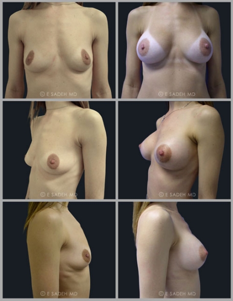 הגדלת חזה לפני ואחרי ניתוח