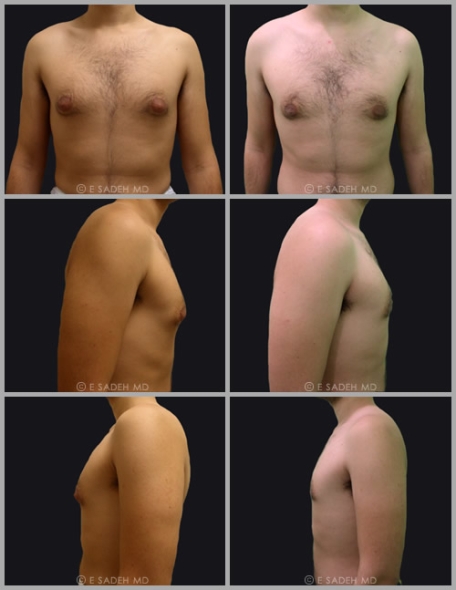 לפני ואחרי שאיבת שומן לגבר