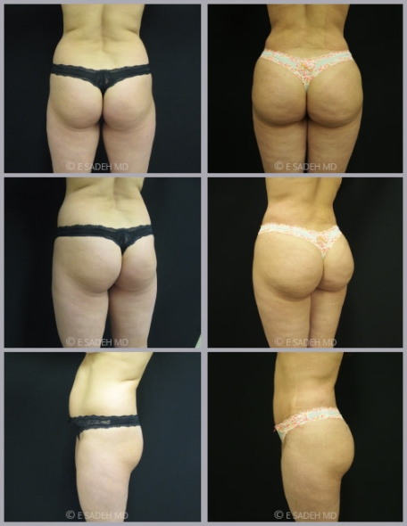 ניתוח שאיבת שומן לפני ואחרי תמונות