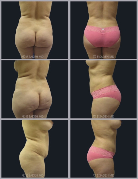 שאיבת שומן לפני ואחרי הניתוח