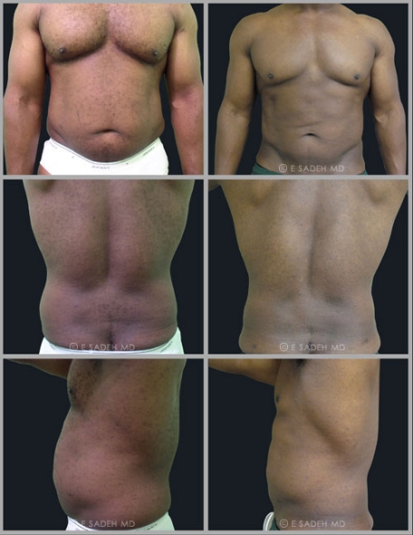 תמונה לפני ואחרי שאיבת שומן לגבר