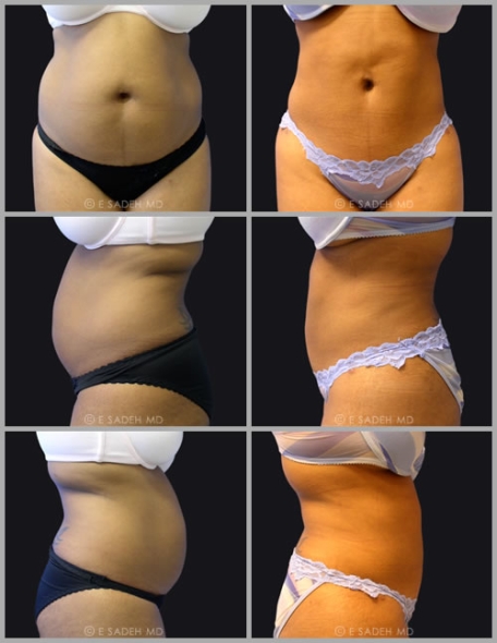 תמונות לפני ואחרי ניתוח לשאיבת שומן