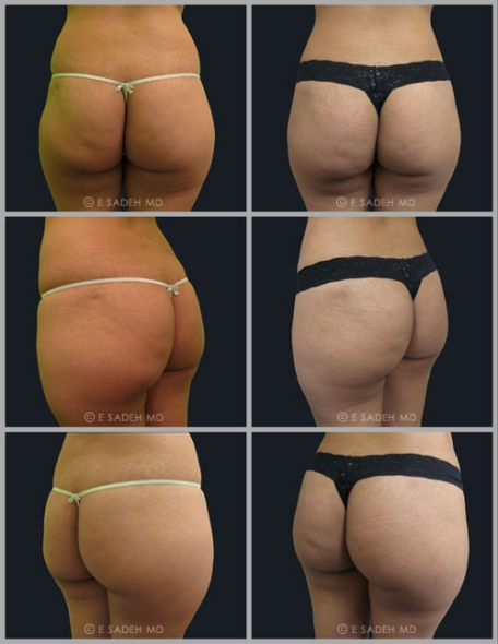 תמונות לפני ואחרי ניתוח שאיבת שומן