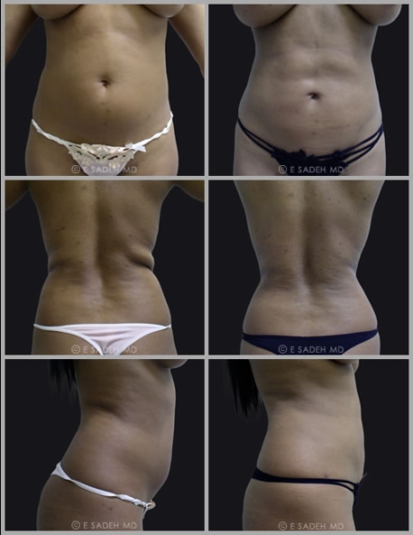 תמונות לפני ואחרי שאיבת שומן
