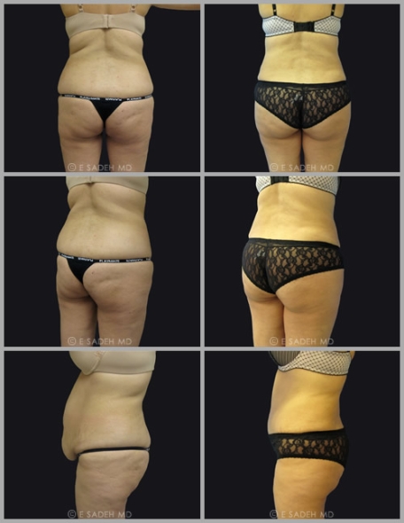 תמונות שאיבת שומן לפני ואחרי